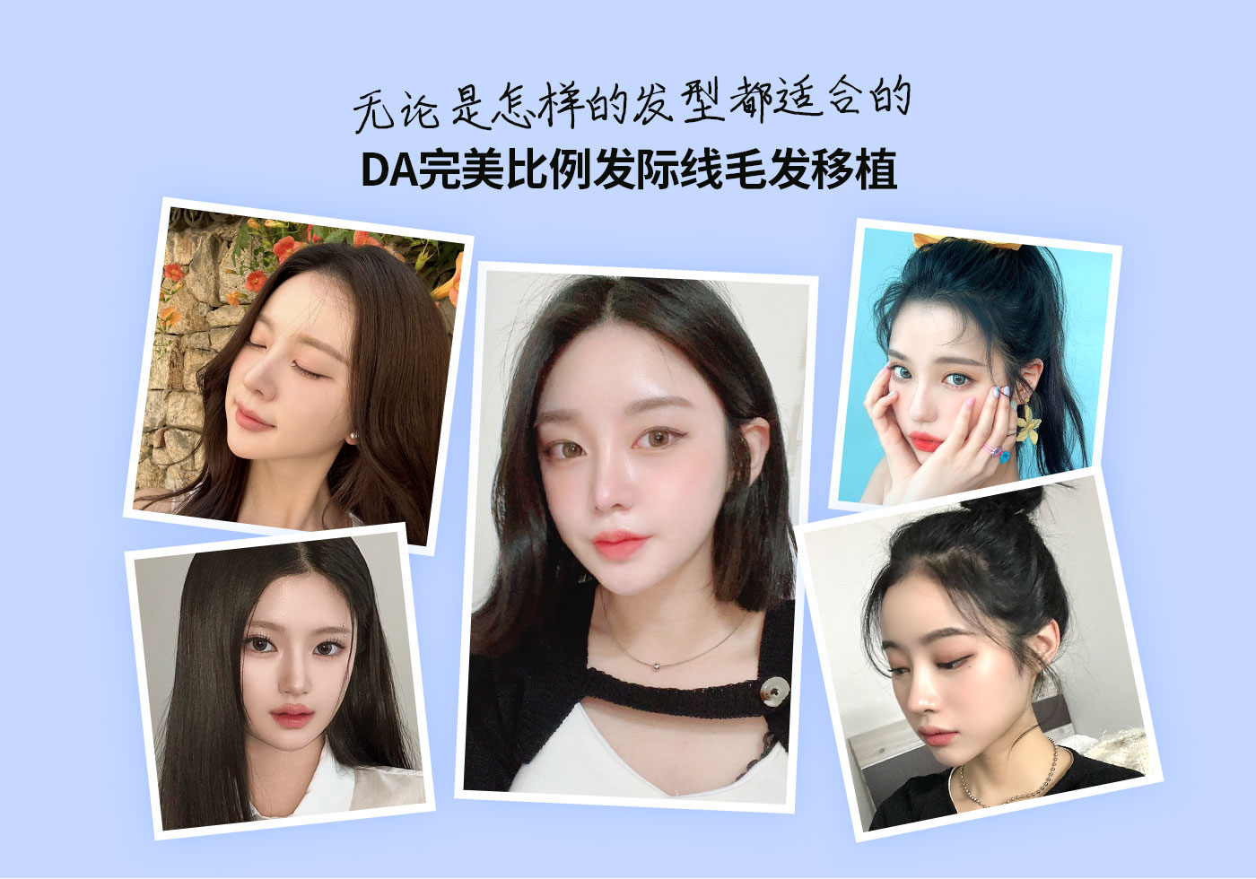 无论是怎样的发型都适合的DA完美比例发际线毛发移植