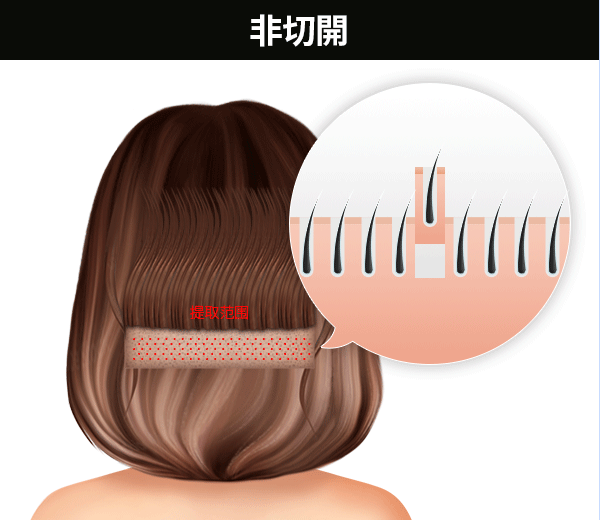 非切开