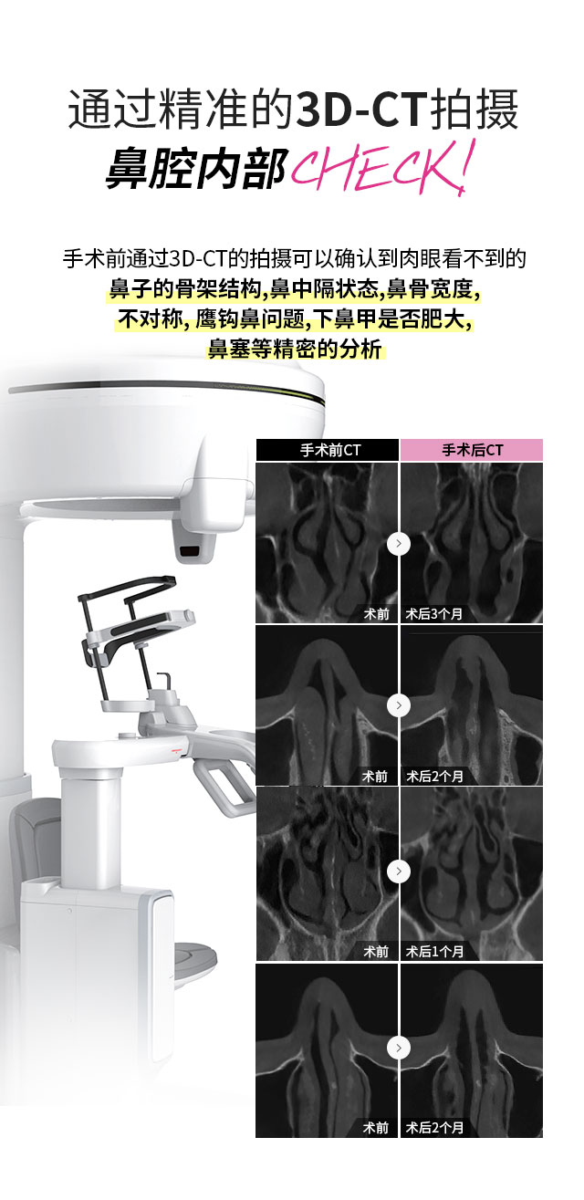 通过精准的3D-CT拍摄鼻腔内部 CHECK!