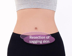  切除下垂皮肤Resection of sagging skin