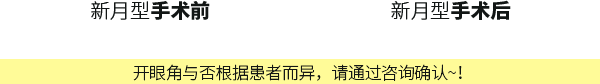 新月型手术前&手术后