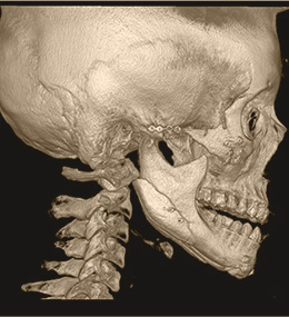 面部轮廓再造CT术前术后