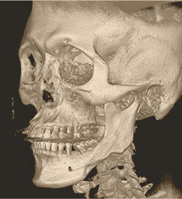 面部轮廓再造CT术前术后