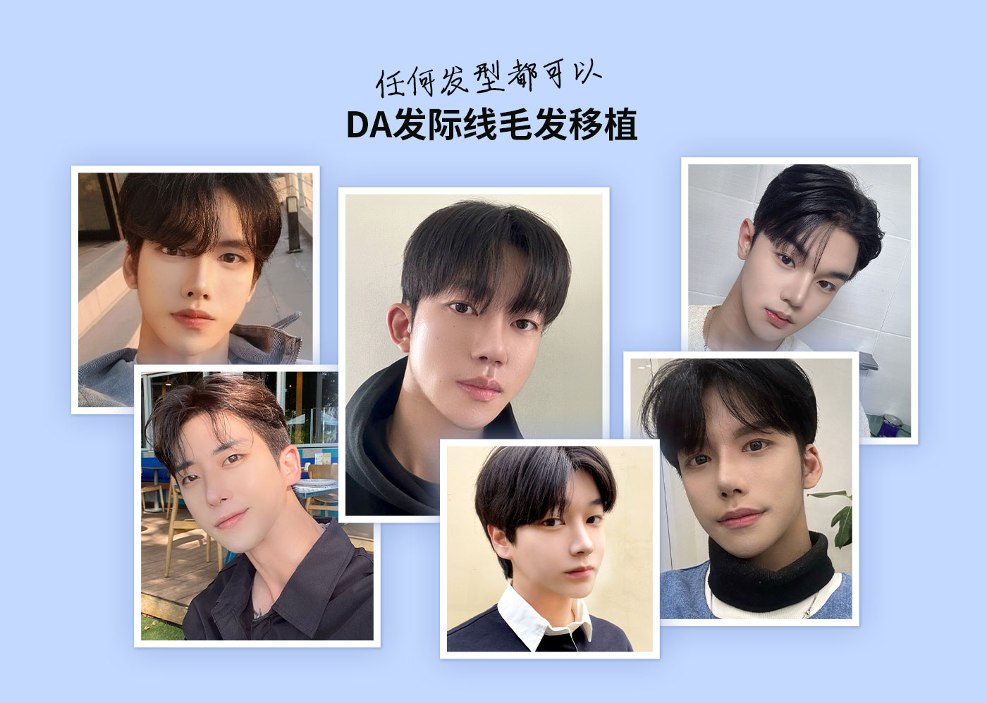 任何发型都可以DA发际线毛发移植