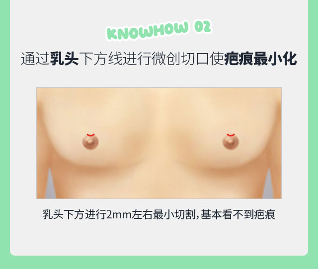 男性乳腺发育症