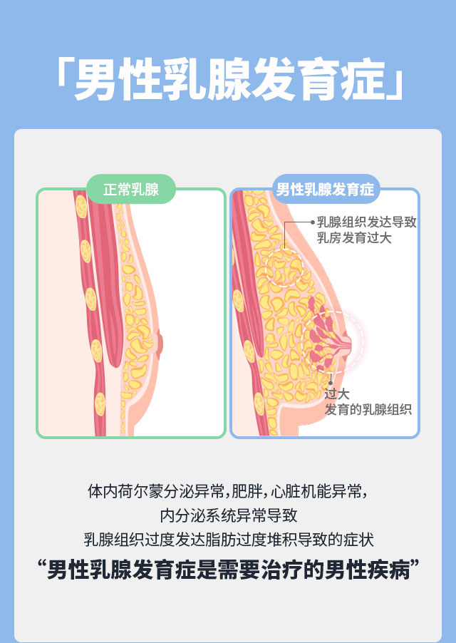 男性乳腺发育症