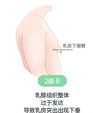 男性乳腺发育症