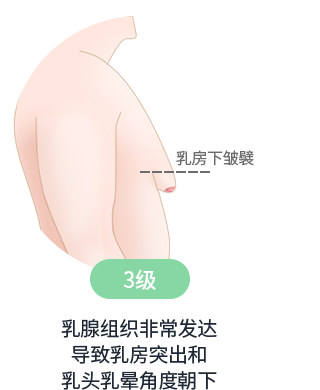 男性乳腺发育症