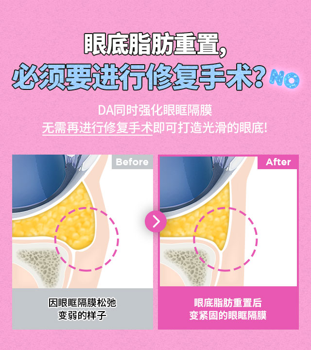 DA眼底脂肪重置