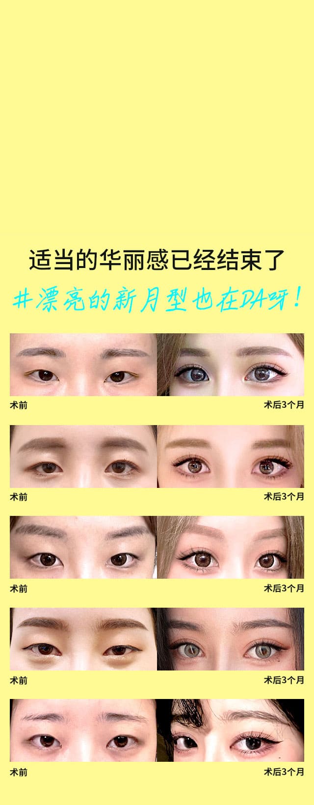 DA新月型双眼皮