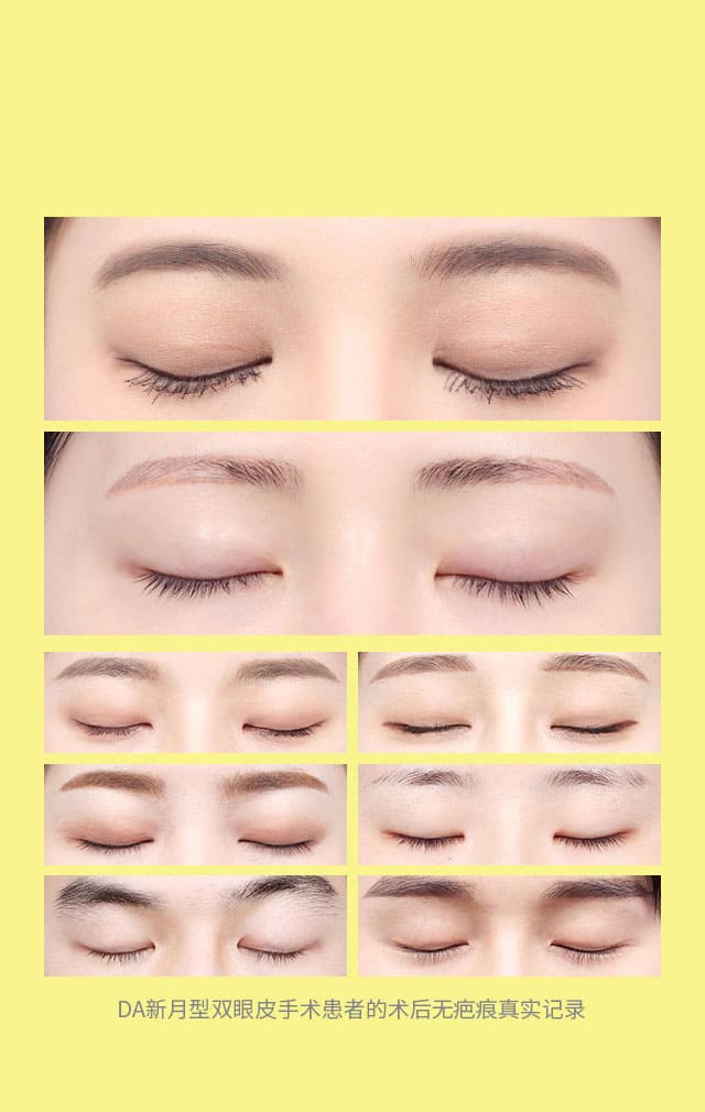 DA新月型双眼皮