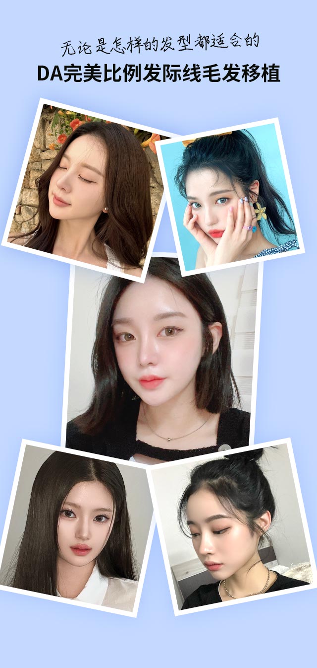 无论是怎样的发型都适合的DA完美比例发际线毛发移植
