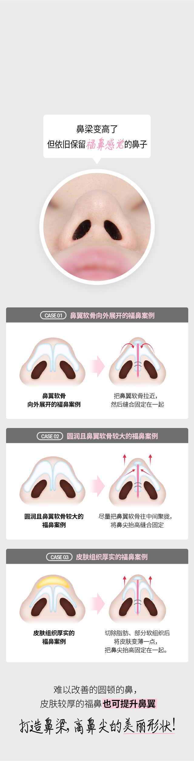 DA鼻修复整形