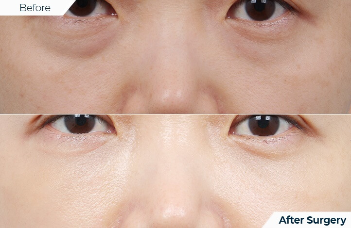 상품15前后照片