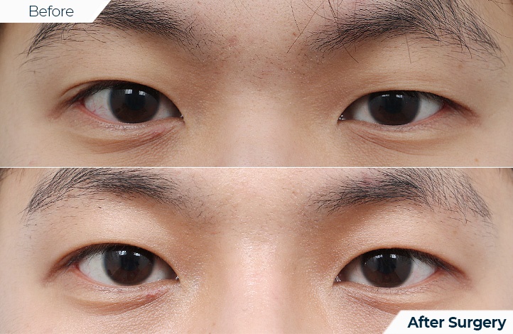 상품30前后照片