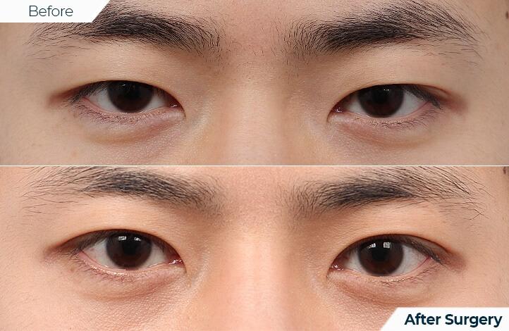 상품31前后照片