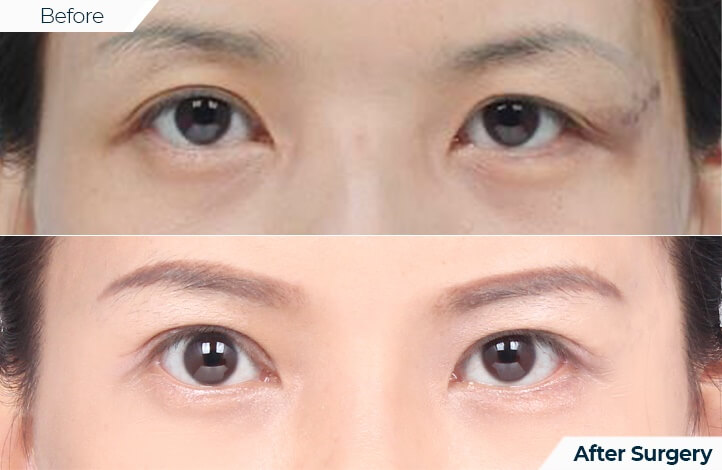 상품32前后照片