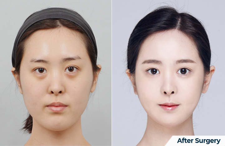 상품39前后照片