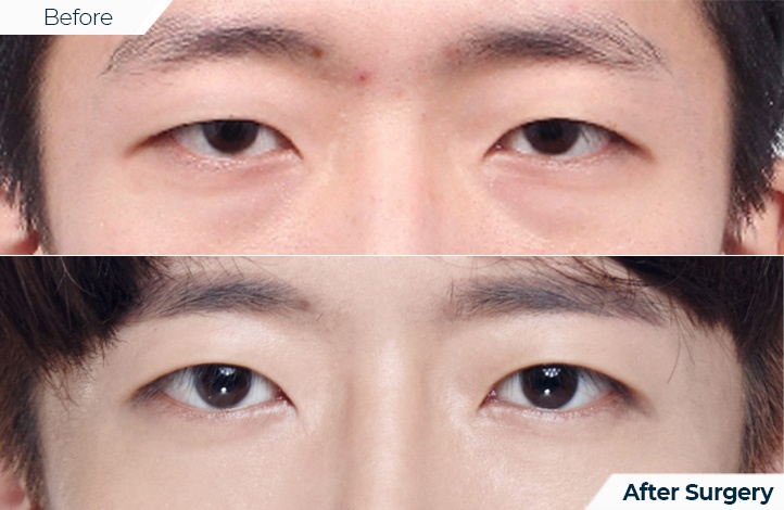 상품42前后照片