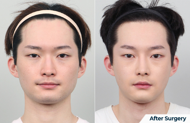 상품52前后照片