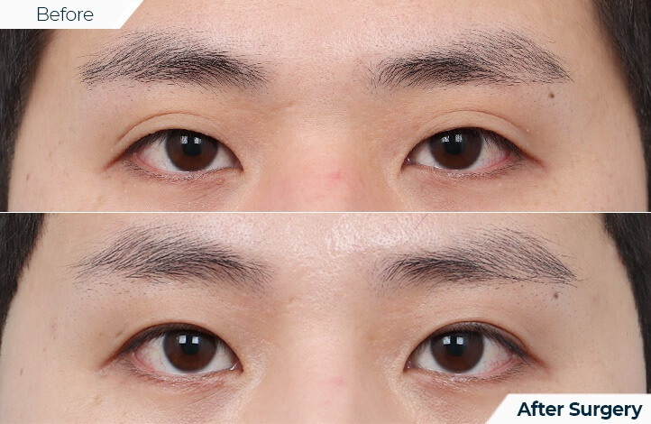 상품69前后照片