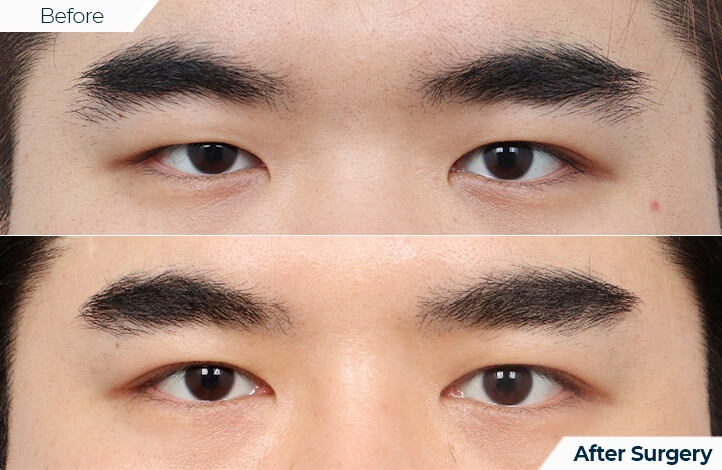 산품71前后照片