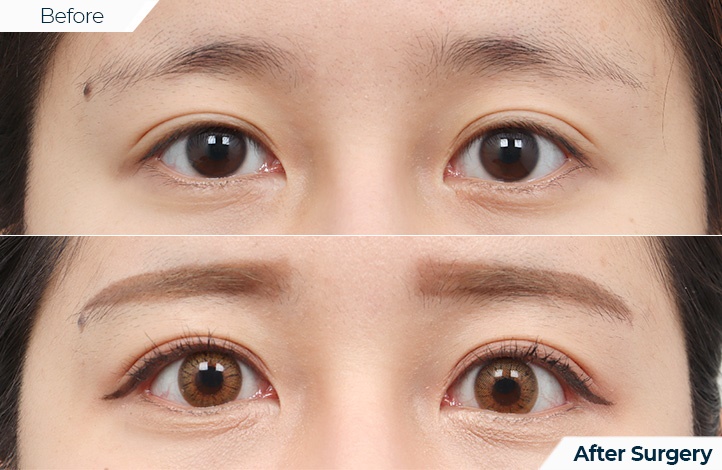 상품72前后照片