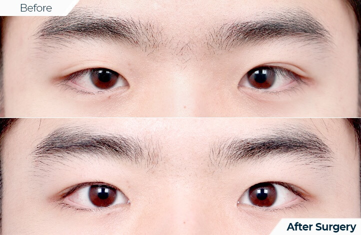 상품85前后照片