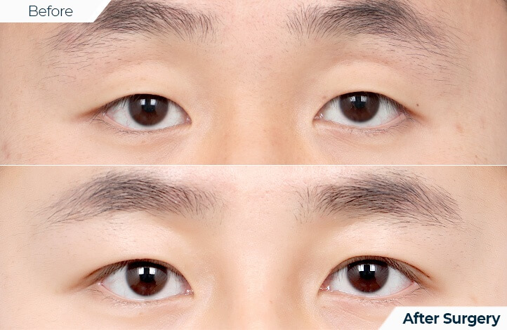 상품92前后照片