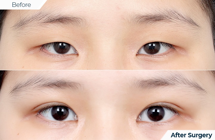 상품93前后照片