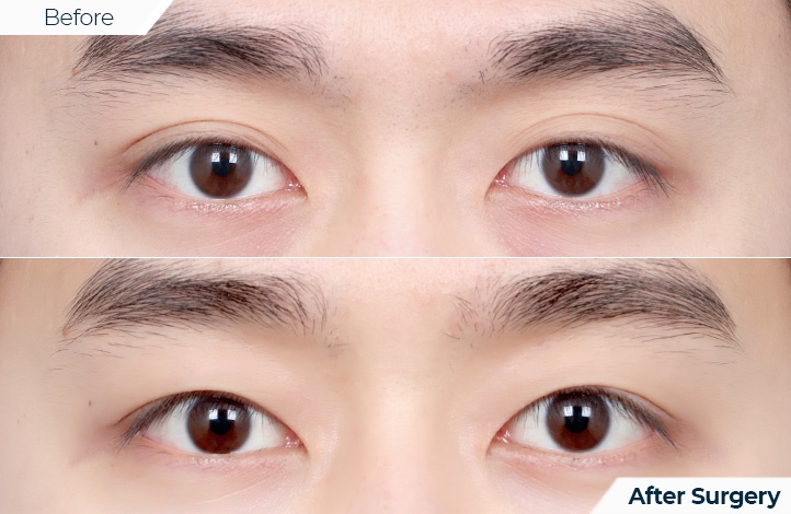 상품94前后照片