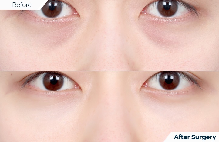 상품95前后照片