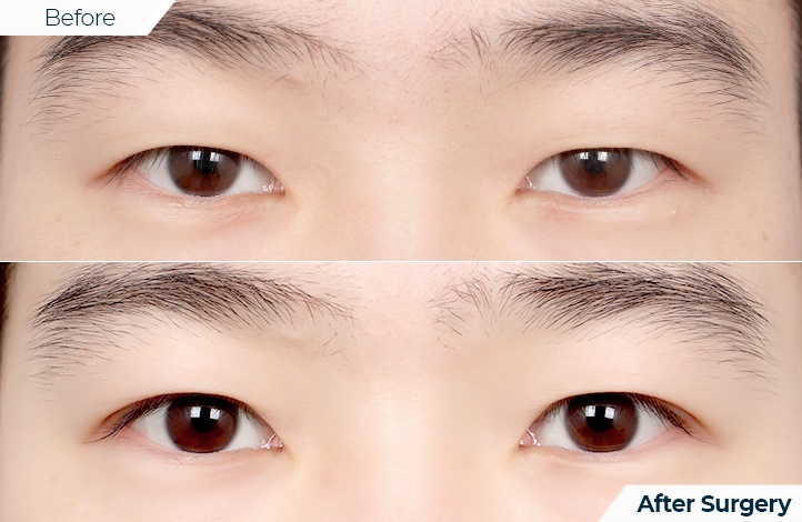 상품101前后照片