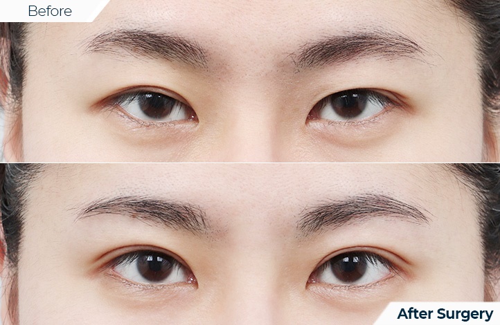 상품103前后照片