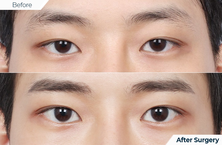 상품110前后照片