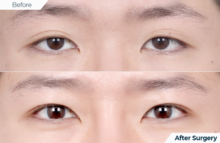 상품112前后照片