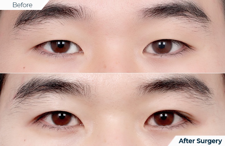 상품113前后照片