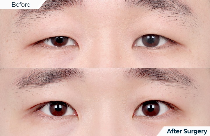 상품114前后照片