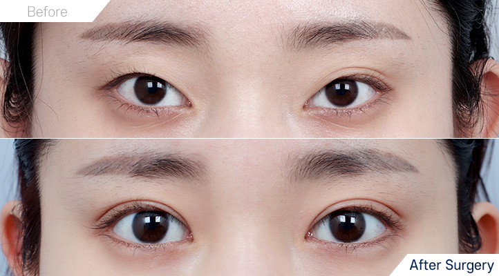 상품124前后照片