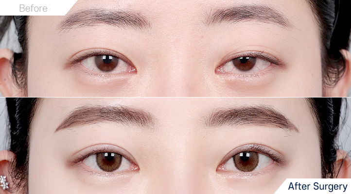 상품126前后照片