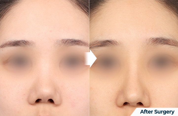 nose 55前后照片