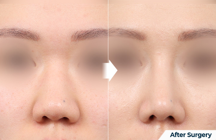 nose 77前后照片