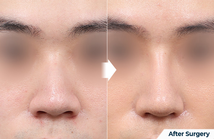 nose 78前后照片