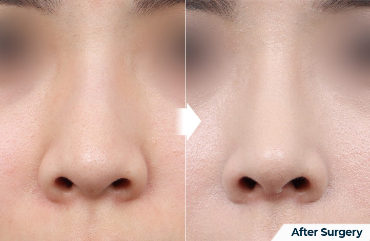 nose 79前后照片