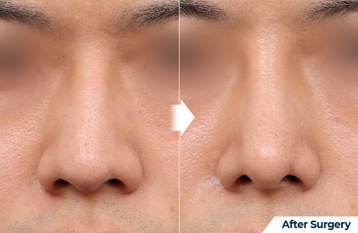 nose 80前后照片