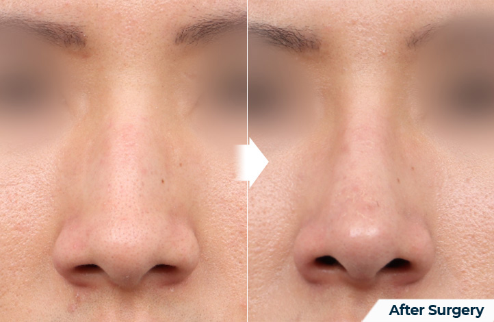 nose 81前后照片