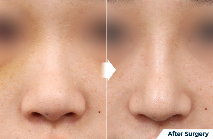 nose 82前后照片