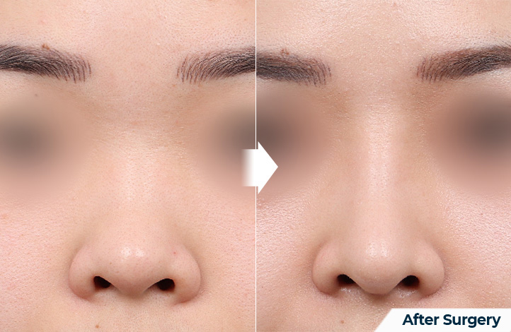 nose 84前后照片