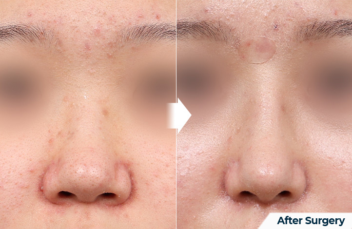 nose 85前后照片
