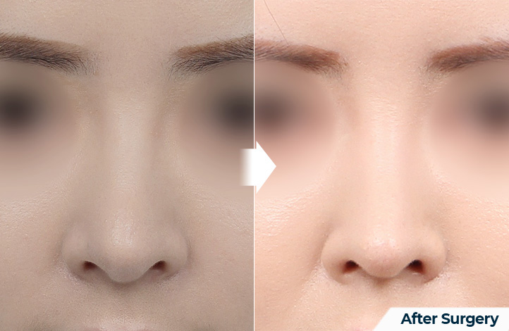 nose 91前后照片